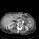 Intraperitoneal hemorrhage, mimic of carcinosis, subcapsular hematoma of the liver: CT - Computed tomography